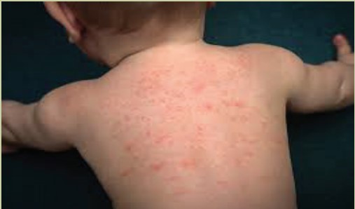 Baby Rash Treatment with Skiinprot